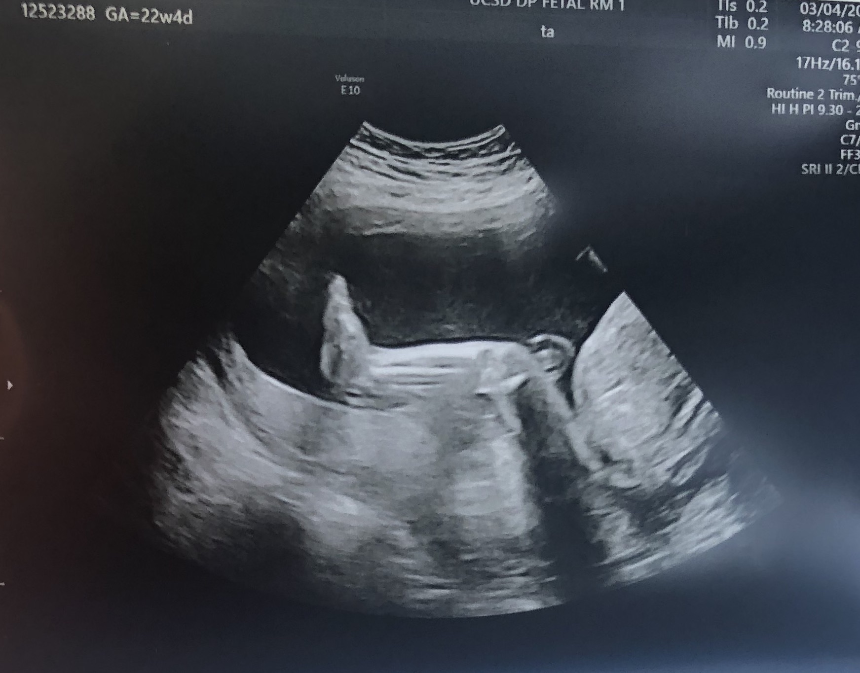 baby rathke ultrasound